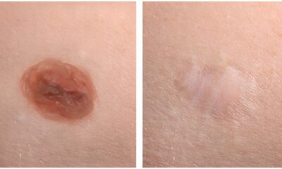 Mole Removal Without a Needle or Surgery: A Safe and Effective Solution