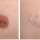 Mole Removal Without a Needle or Surgery: A Safe and Effective Solution