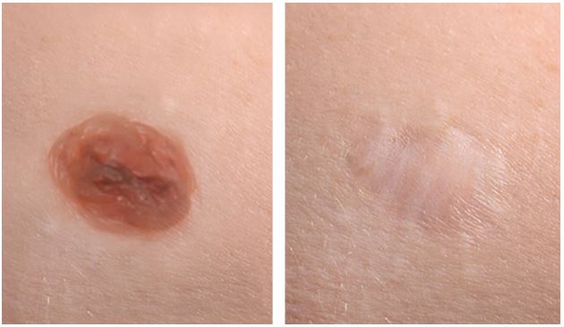 Mole Removal Without a Needle or Surgery: A Safe and Effective Solution